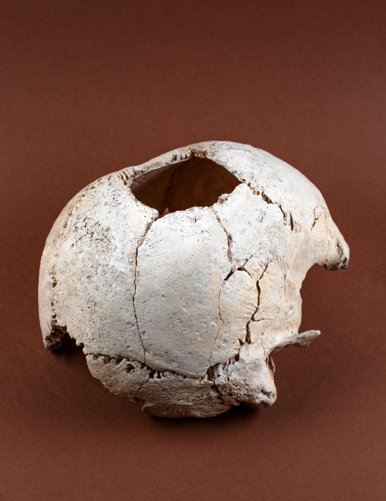 Este cráneo trepanado se conserva en el museo Bibat de arqueología de Álava